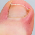 ingrown toenail removal doctor
