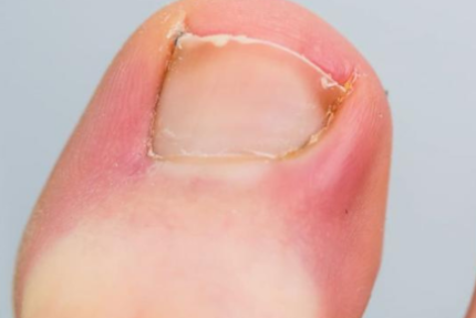 ingrown toenail removal doctor