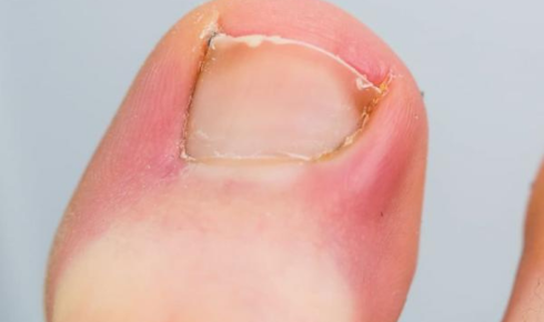 ingrown toenail removal doctor